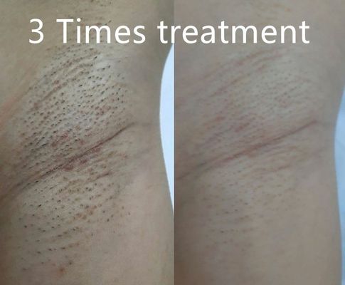 Многофункциональный диодный лазерный аппарат для удаления волос, поддерживающий различную ширину импульса для индивидуального перманентного уменьшения волос