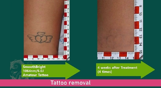 1064nm Q Switched Nd Yag Laser Пикосекундная машина для удаления татуировок