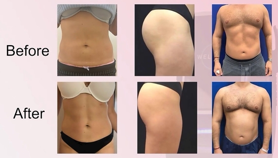 15 Tesla RF EMS Slimming Machine для контура тела / укрепления мышц