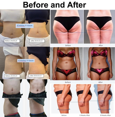 Водонепроницаемая EMS Slimming Machine 5000W Neo RF EMS Стимулятор мышечного наращивания